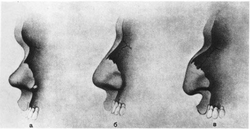Зависимость формы носа от строения костей