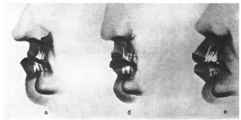 Влияние прикуса на форму губ
