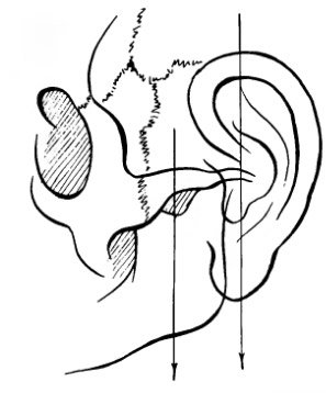 Связь скулового отростка с ушной раковиной